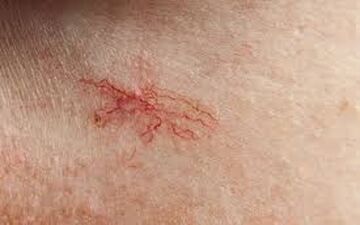 دلیل ظهور «رگ‌های عنکبوتی» (روزاسه) روی صورت چیست؟