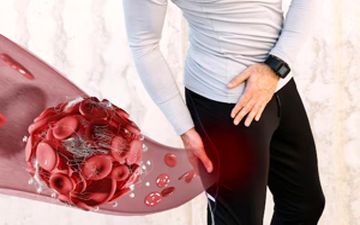 خطرات لخته در پا+راهکارهای طلایی پیشگیری از لخته شدن خون در پا