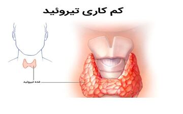 بی علامتی مشکل تیروئید در نوزادان؛غربالگری بهترین راهکار!