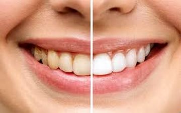 رنگ دندان چه چیزهایی درباره سلامت شما می‌گوید؟