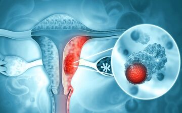 علایم شایع سومین سرطان شایع زنان چیست؟ | بهترین سن برای تزریق واکسن HPV برای زنان |آیا مردان هم می‌توانند واکسن HPV بزنند؟
