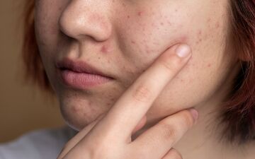 غذاهای جوش آور؛ چه غذاهایی باعث جوش زدن صورت می شود