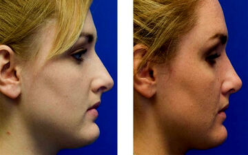 ترمیم افتادگی نوک بینی