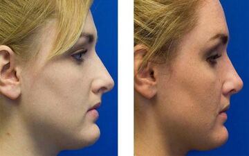 ترمیم افتادگی نوک بینی