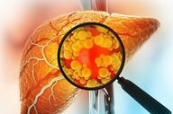 کبدت چند درجه چرب شده؟ اینفوگرافیک + درجه‌بندی واقعی!