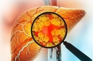 کبدت چند درجه چرب شده؟ اینفوگرافیک + درجه‌بندی واقعی!