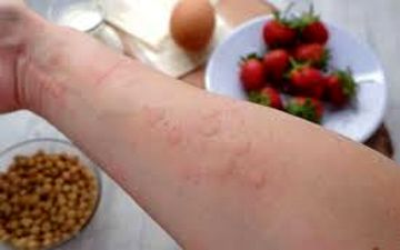 آلرژی‌های غذایی از چه سنی ممکن است شروع شود؟