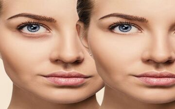 راهکارهای مؤثر برای رفع گودی زیر چشم| گودی زیر چشم را سه سوته درمان کنید
