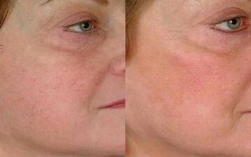 دلایل ایجاد رگ‌های عنکبوتی بر روی صورت چیست؟ + درمان 