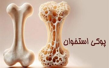 وقتی کودکان دچار پوکی  می‌شوند؛ واقعیتی که باید جدی گرفته شود