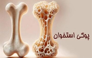 وقتی کودکان دچار پوکی  می‌شوند؛ واقعیتی که باید جدی گرفته شود