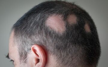 درباره  کچلی سکه ای چه میدانید؟