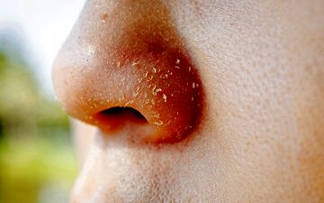پوسته پوسته شدن روی بینی| دلیل پوسته پوسته شدن روی بینی چیست؟