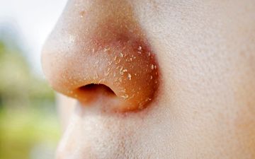 پوسته پوسته شدن روی بینی| دلیل پوسته پوسته شدن روی بینی چیست؟