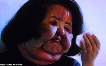 وحشتناک ترین چهره ی دنیا /بر اثر جراحی های متعدد