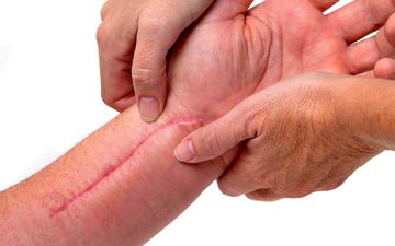 چه کنیم جای زخم از بین برود؟
