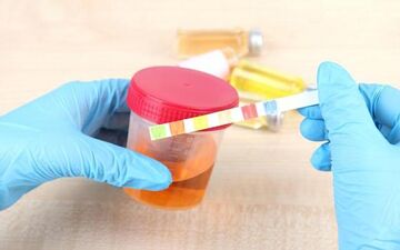 دلیل رنگ‌های غیر طبیعی ادرار چیست؟شایع‌ترین دلایل ادرار نارنجی رنگ
