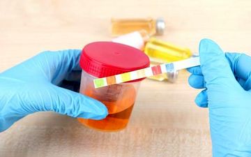 دلیل رنگ‌های غیر طبیعی ادرار چیست؟شایع‌ترین دلایل ادرار نارنجی رنگ
