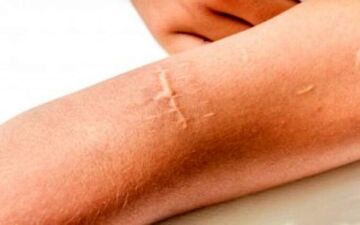 جای زخم را چگونه از بین ببریم؟