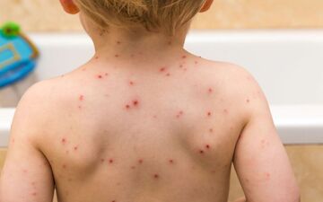 آیا آبله مرغان خطرناک است؟