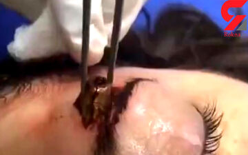 برخورد گلوله به صورت دختر 15 ساله +فیلم (+16)