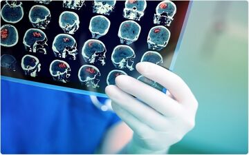 تجمع آهن در سلول های مغزی خطرناک است
