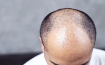 کمبود این ویتامین باعث ریزش مو می‌شود

