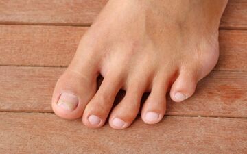 زرد شدن ناخن دست و پا نشانه چیست؟