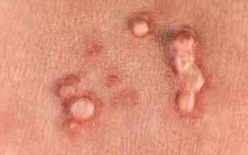 چگونه میشود فهمید که HPV داریم؟

