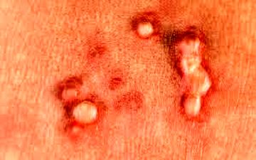 چگونه میشود فهمید که HPV داریم؟

