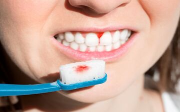 دلایل خونریزی لثه ها چیست؟