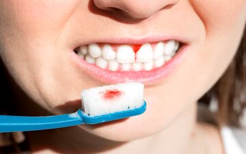 دلایل خونریزی لثه ها چیست؟