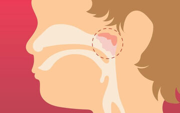 چرا باید لوزه سوم را جراحی کنیم؟