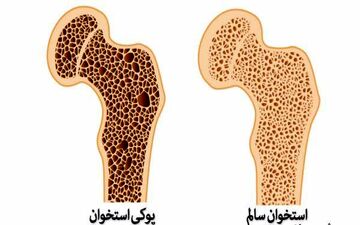 پوکی استخوان و سارکوپنی دو بیماری خاموش سنین بالای ۵۰ سال