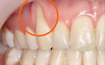 علت عقب‌رفتگی لثه چیست؟