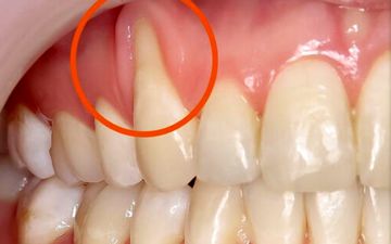 علت عقب‌رفتگی لثه چیست؟