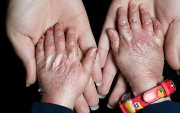 بیماران انگشت‌شماری که دردهایشان بی‌شمار است