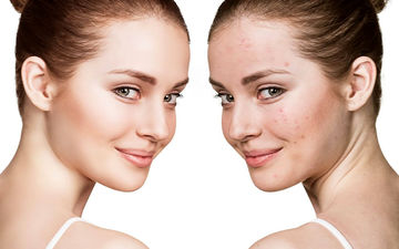 چگونه جای جوش را از بین ببریم؟