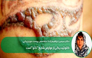 کلوئید، شایع ترین عوارض تاتو