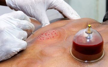حجامت می‌تواند جایگزین واکسن کرونا باشد؟