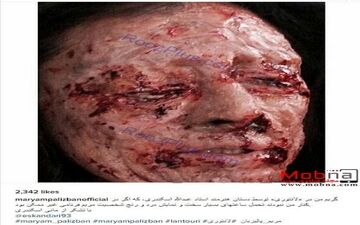 تصویری دلخراش از اسیدپاشی روی صورت خانم بازیگر!