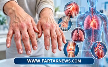بیماری بافت همبند مختلط چیست؟ اختلال خودایمنی با علائم چند بیماری روماتیسم