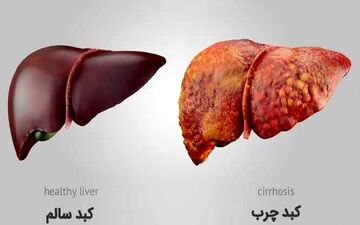 با این سه مورد کبد چرب تان را درمان کنید