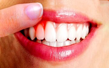راه‌های مقابله با عفونت لثه