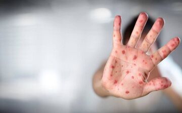 همه چیز درباره آبله میمونی

