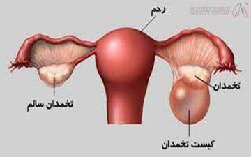 آیا کیست‌های تخمدانی علائم خاصی دارند؟