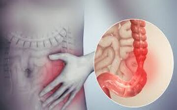 عوامل ایجاد سندروم روده تحریک پذیر