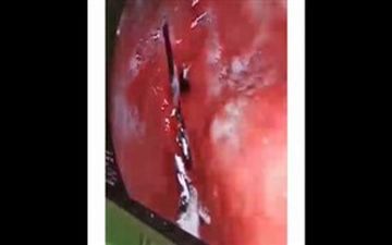 خارج کردن سوزنی بزرگ از معده زنی در یزد/ او ۲۱ روز سوزن را در شکمش تحمل کرد