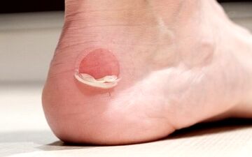از تاول زدن چگونه پیشگیری کنیم؟