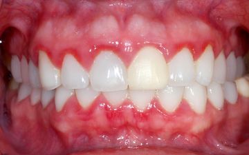 مهم ترین دلایل خونریزی لثه/نقش داروهای خاص 